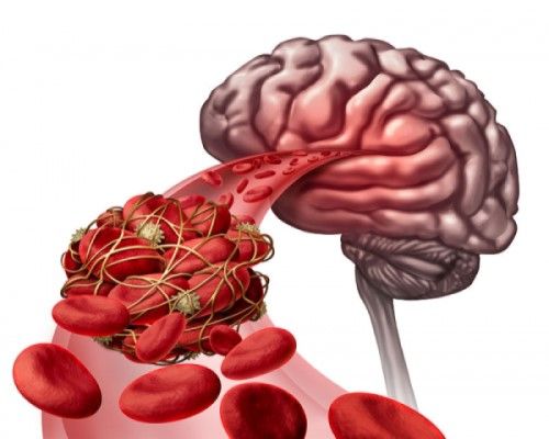 โรคหลอดเลือดสมองตีบ (Ischemic stroke)