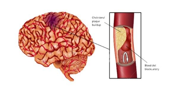 Ischemic stroke